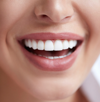 Teeth Whitening