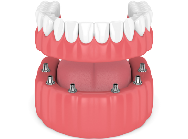 Implant retained dentures