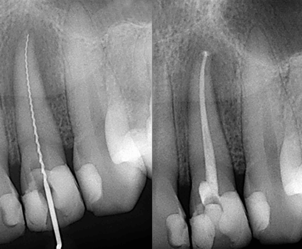What are the causes and signs of endodontic disease or damage?