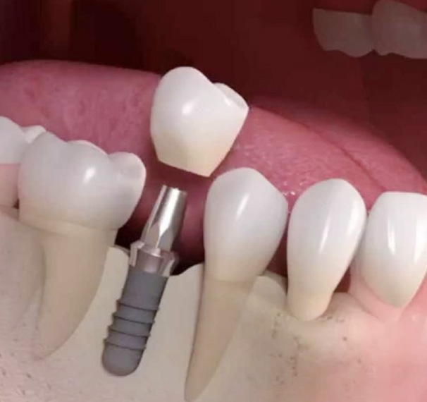 What is a dental implant