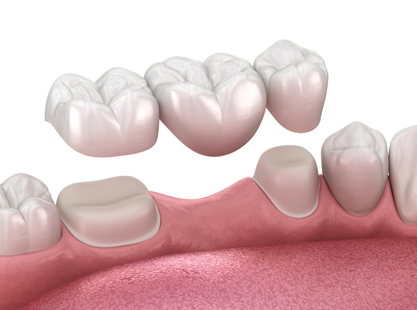 what is a dental bridge